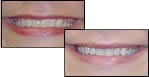 Immediate Teeth Whitening Results with Oxford OH Dentist Dr. Lloyd