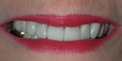 After Veneers near Cincinnati OH