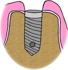 Implant Stitch Dentist Oxford OH