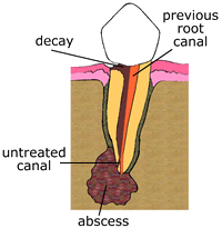 abscess