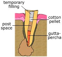 temporary filling