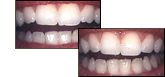 Enamel Shaping with Dr. Lloyd