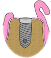 Dental Implants Anchor near Cincinnati OH