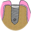 Implant Stitch Dentist Oxford OH