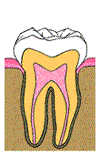 root canal