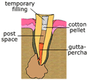 temporary filling